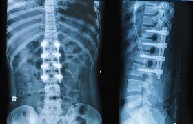 Spinal surgery